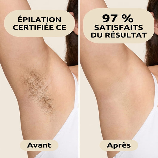 Épilation définitive à la lumière pulsée